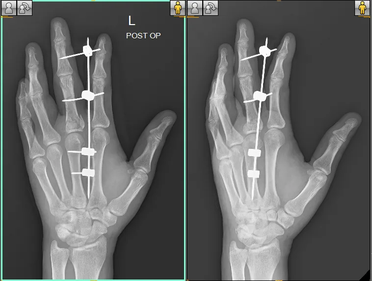 MR-KAMLESH-POST-OP-XRAY-e1678688828236