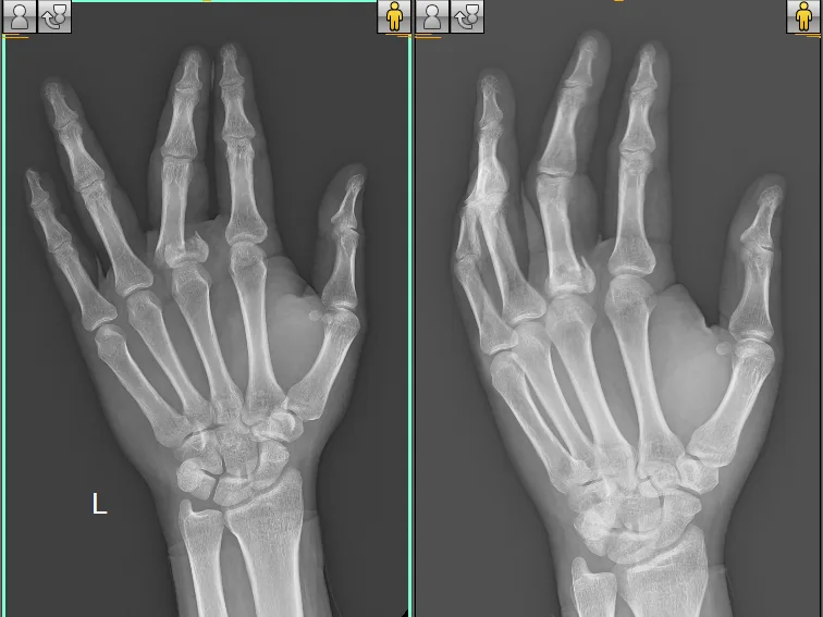 MR-KAMLESH-PRE-OP-XRAY-e1678688849309