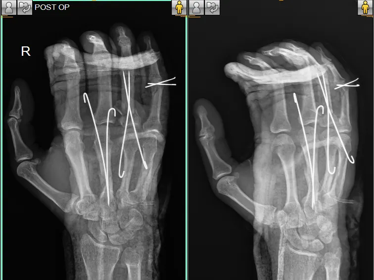 MR-PRASAD-HAND-POST-OP-e1678688966479