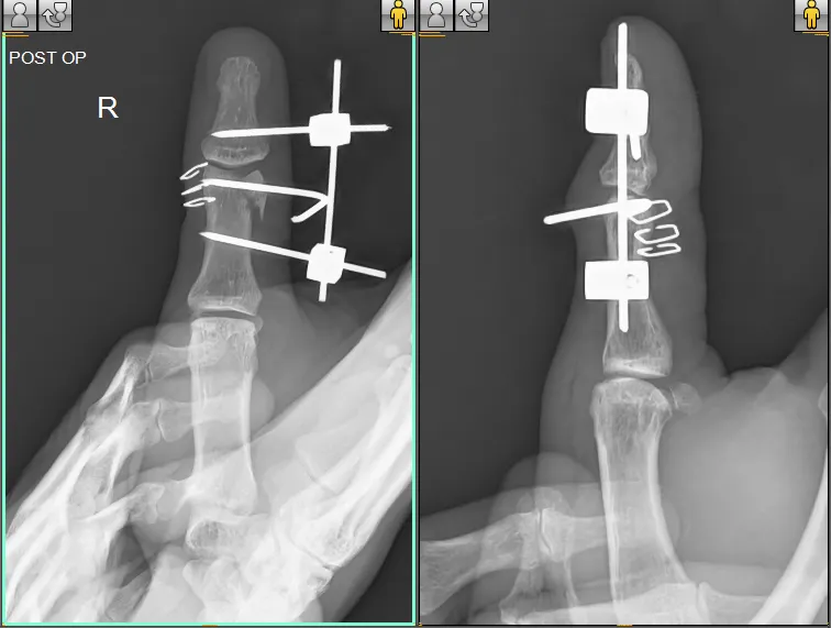 MR-RATHIKANT-POST-OP-XRAY-THUMB-APLAT-e1678689063768