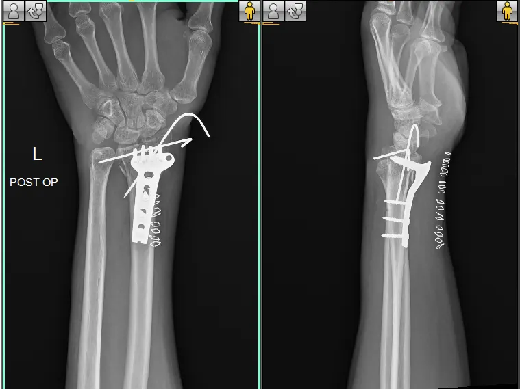 MR-RAVIKUMAR-POST-OP-WRIST-e1678689226952