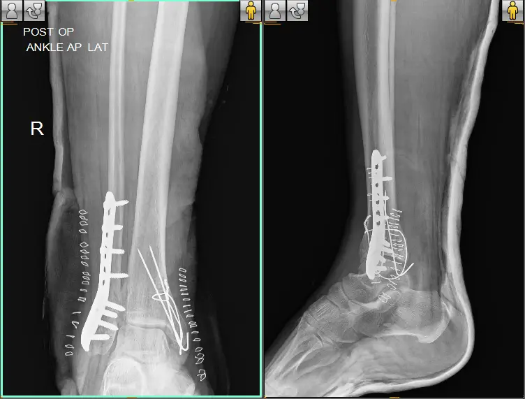 MRS-AMUTHAVALLY-POST-OP-e1678689410522