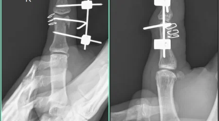 Pre and Post XRAYS